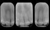 Fig 10. Placement of orthodontic wire at the gingival margins (Fig 9), and radiographs showing radiopaque markers for detection of CEJ and gingival margins (Fig 10).