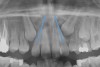 Fig 4. Impacted canine, radiographic signs. Lateral incisor crown distal flaring is apparent.