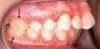 Fig 9. Anteroposterior view of class II (Fig 9) and class III (Fig 10) malocclusion. Arrows indicate positions of the mesial maxillary cusp and embrasure between the mandibular molar cusps. In class II malocclusion the maxillary molar is more anteriorly positioned, while in class III the mandibular molar is more anteriorly positioned.