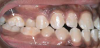 Fig 10. Anteroposterior view of class II (Fig 9) and class III (Fig 10) malocclusion. Arrows indicate positions of the mesial maxillary cusp and embrasure between the mandibular molar cusps. In class II malocclusion the maxillary molar is more anteriorly positioned, while in class III the mandibular molar is more anteriorly positioned.