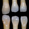 Fig 2. Standard deviation, lateral incisors.