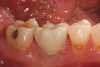 Fig 2. Patient in Figure 1 who received BPCS graft shown 5 years after prosthetic loading of the implant.