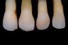 Fig 19. Lateral incisors: cross-polarization.