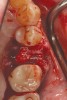 Fig 10. The deficient socket was grafted and the barrier trimmed and positioned over the bone replacement graft material, enabling ideal formation of the final ridge shape.