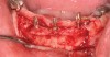 Fig 12. Deficient anterior mandibular ridge with transitional implants in place to retain a transitional fixed prosthesis, eliminating the chance of premature loading over the surgical site.