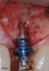 Fig 2. Implant placement using standard burs may potentially lead to off-axis drilling, which at times may compromise implant outcomes or long-term esthetic results. These three photographs show examples of cases in which multiple implant threads were left exposed due to thin buccal bone relative to the implant placement (clinical photographs courtesy of Salah Huwais, DDS).