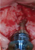Fig 4. Implant placement using standard burs may potentially lead to off-axis drilling, which at times may compromise implant outcomes or long-term esthetic results. These three photographs show examples of cases in which multiple implant threads were left exposed due to thin buccal bone relative to the implant placement (clinical photographs courtesy of Salah Huwais, DDS).
