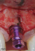Fig 3. Implant placement using standard burs may potentially lead to off-axis drilling, which at times may compromise implant outcomes or long-term esthetic results. These three photographs show examples of cases in which multiple implant threads were left exposed due to thin buccal bone relative to the implant placement (clinical photographs courtesy of Salah Huwais, DDS).