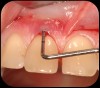 Severe periodontitis lesion.