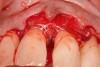 A resorbable membrane sutured around the teeth bordering the intrabony defect.