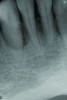 A significant intrabony defect around tooth No. 27.