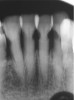 Fig 7. The lower incisors were responsive to electric pulp testing with no radiographic pathology.