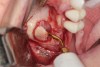 Fig 3. Lateral sinus augmentation; an initial window was created using a combination of a round fissure bur and, as shown, a piezosurgery device tip.