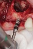 Fig 6. OD burs were used to create implant osteotomies. OD burs were preferred in this clinical situation to compact the remaining bone by utilizing their counterclockwise rotation, enhancing the densification of bone.