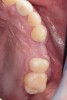 Fig 10. Clinical image demonstrating loss of maxillary left first bicuspid along with a resorbed posterior ridge.