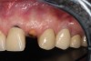 Fig 16. Patient presented with fractured maxillary left lateral incisor. Radiographic analysis (not shown) revealed minimal buccal bone. A socket shield was planned during tooth extraction to preserve gingival contours.