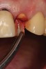 Fig 17. The root was sectioned mesial-distal, followed by removal of the palatal root half.