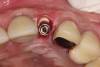 Fig 20. After placement of bone grafting putty in the defect, the implant was inserted. Note the remaining bone grafting putty on the buccal aspect of the implant.