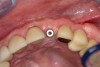 Fig 21. Soft-tissue healing after 3 months. Note maintenance of the facial gingival zenith.