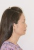 Fig 2. Lateral profile before treatment.