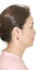 Fig 10. Lateral profile after treatment; note shallower chin depression.