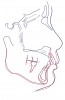 Fig 14. Cephalometric superimposition; black lines indicate pretreatment, and red lines indicate post-treatment.