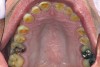 Fig 1. Upper occlusal view, showing severe attrition and lingual erosion on maxillary teeth.