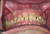 Fig 2. Frontal intraoral view, showing severe attrition on maxillary teeth.