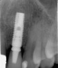 Figure 3  Identification of sufficient inter-radicular space: The radiographic representation of inter-radicular space (Fig 2) reveals abundant space for a single-tooth implant; at the alveolar crest, > 6 mm of interproximal space is available for placement of a 4-mm implant without encroaching on bone and periodontal ligament at the adjacent teeth. The 5-year-follow-up radiograph (Fig 3) reveals the interproximal maintenance of bone at this implant/abutment interface and adjacent teeth, in part due to proper planning and implant placement.