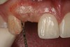 Figure 11   Clinical examination of the bound edentulous space: Measurement of the distal (Fig 10) and mesial (Fig 11) interproximal tissue height using a periodontal probe supplements data obtained from the periapical radiograph. Estimation of the buccal tissue thickness (bone sounding) is performed at the determined location of the gingival zenith using a guide developed from the diagnostic waxing (Fig 12).