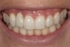 Fig 3. A patient presented with a high smile line and midfacial recession of the maxillary right lateral incisor as evidenced by the increased tooth length compared with the contralateral lateral incisor.