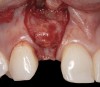 Fig 8. A subepithelial connective tissue graft was placed.