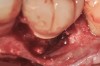 Fig 18. A full-thickness flap from teeth Nos. 18 to 20 revealed granulomatous tissue in the circumferential defect around implant No. 19.