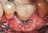 Fig 22. Copious irrigation with dilute hydrogen peroxide was used to chemically detoxify the surface of the implant and the bony defect.