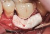 Fig 24. The bone graft was covered with dermis allograft that will act as a barrier to prevent epithelial downgrowth while simultaneously augmenting the vestibule and thin marginal gingiva that were contributing to the mucogingival problem.