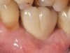 Fig 27. Seventeen-month follow-up showing keratinized gingiva at the free gingival margin, resolution of the recession defect and deepening of the vestibule. Fig