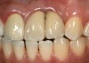 Fig 30. The intraoral view of the loss of the interdental papilla between teeth Nos. 9 and 10.