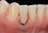 Fig 35. A transitional resin-bonded-retained (RBR) bridge that was tooth supported was placed to allow soft-tissue maturation.