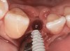 Fig 43. A full thickness flap was raised to place a new 3.25-mm implant into tooth No. 26 area in a single-stage protocol.