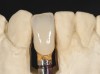 Fig 44. A new metal-alloy abutment was fabricated for the narrow-diameter implant with a cement-retained metal-ceramic crown.