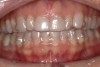 Fig 2. Orthodontic treatment with invisible appliances.