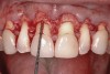 Fig 5. Surgical field after osteoplasty and ostectomy.