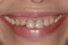 Fig 11. Patient’s initial smile.