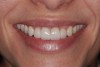 Fig 20. Extraoral view of final result; note the marked reduction of the gummy smile.