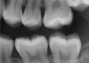 Figure 1 Traditional intraoral bitewing showing limited field of view (Fig 1) compared to the expanded view possible using CBCT (Fig 2).