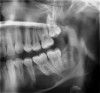 Figure 2 Traditional intraoral bitewing showing limited field of view (Fig 1) compared to the expanded view possible using CBCT (Fig 2).