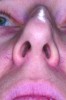 Fig 1. Nasal collapse on left side during nasal inspiration.