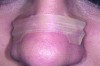 Fig 2. Dilator strips aid with nasal valve stenosis.