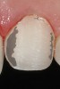 Figure 13  Photograph of the Class III veneer preparation design demonstrating dentin exposure of approximately 20%, falling within the 20% to 50% range for remaining dentin. Note that more than 70% enamel periphery and 50% to 80% enamel remain, which is a crucial consideration criteria for this classification design.