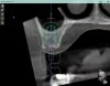 Fig 13. Virtual planning of a posterior implant (Fig 12) resulted in inadequate restorative running room for the crown emergence profile in the cross-sectional CBCT image. Revision (Fig 13) resulted in deeper positioning of the implant for restorative running room but necessitated transcrestal sinus elevation, possibly with the addition of bone via the osteotomy to tent the membrane.